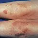 Picture of Ataxia Telangiectasia (Legs)