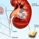 Picture of Kidney Stone