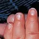 Picture of Nail-Patella Syndrome