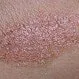Psoriasis Types, Images, Treatments