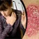 Plaque Psoriasis: Top 10 Causes, Triggers and Treatments