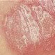 Picture of Psoriasis Vulgaris Plaque