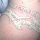 Picture of Tattoo with Q-Switched Laser Treatment