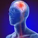 Can a Person Survive a Hemorrhagic Stroke?