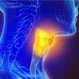 Can You Survive Stage III Throat Cancer?